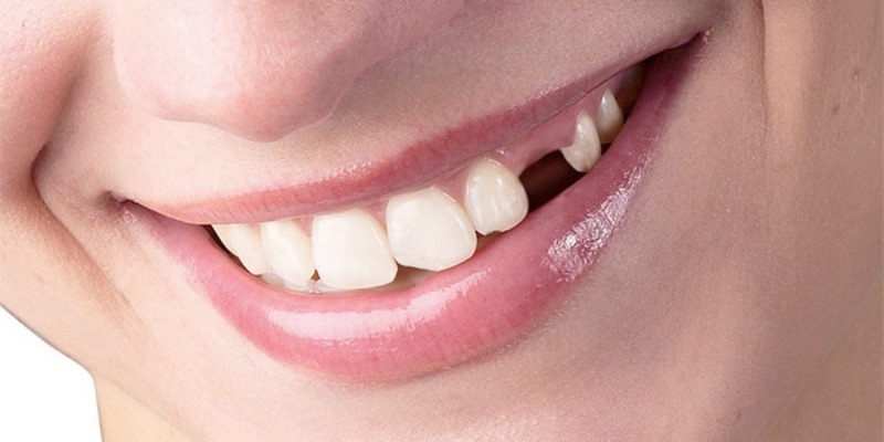 Vì sao lại thường nằm mơ thấy rụng răng?